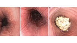 Эозинофильный эзофагит